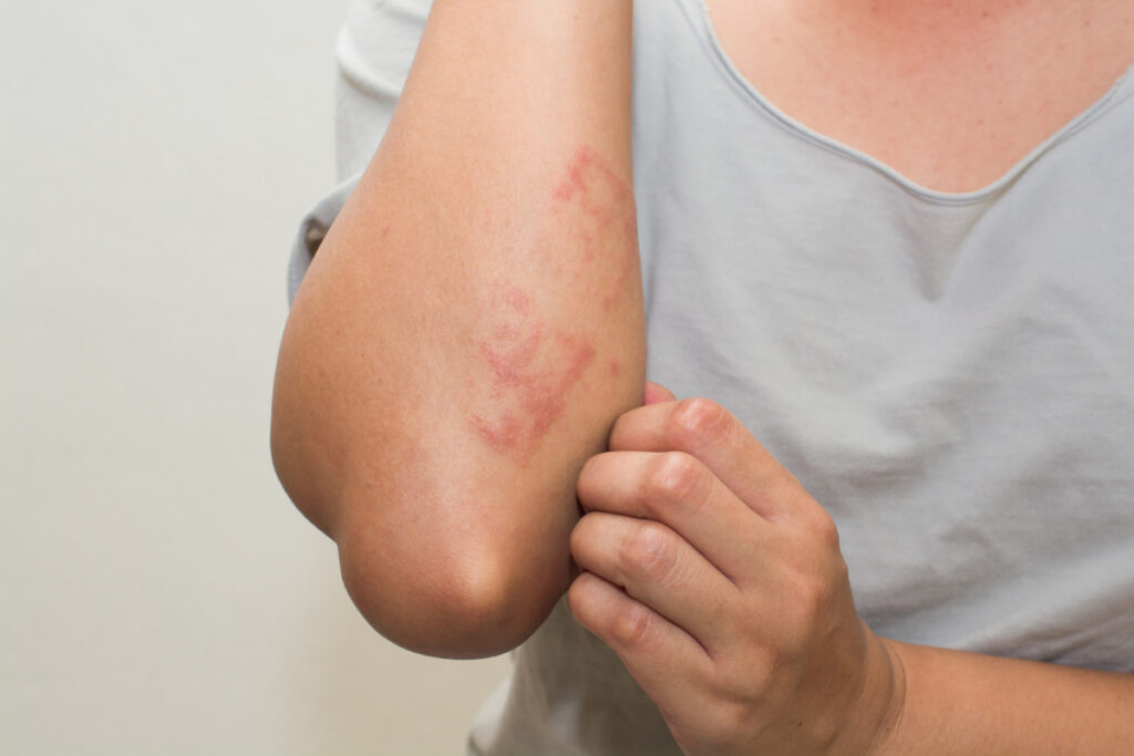ill,allergic,rash,dermatitis,eczema,skin,of,patient