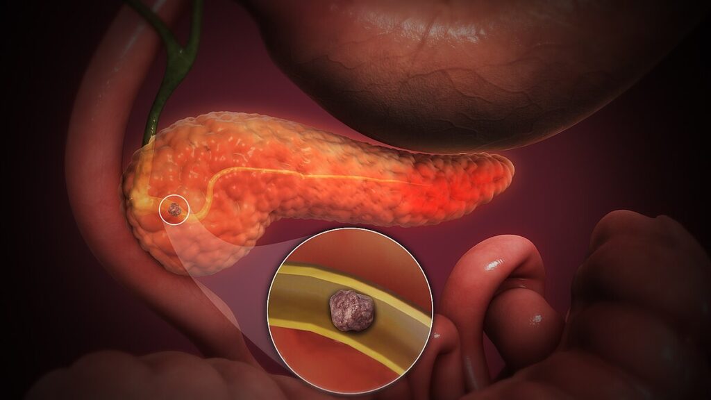 3d medical animation acute pancreatitis