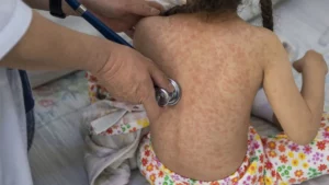 Alerta de la OMS: retorno de la transmisión endémica del sarampión en España